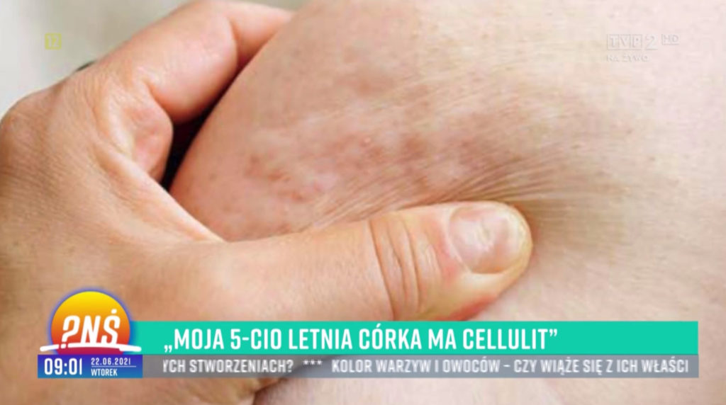 pytanie na sniadanie cellulit tvp class="wp-image-1742329"